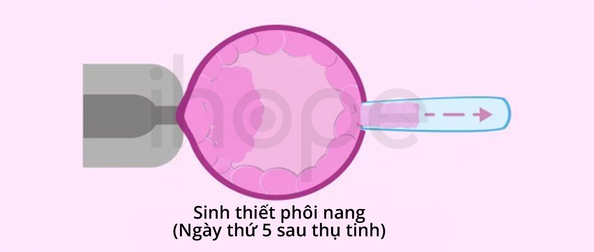 Sinh Thiết Phôi Nang