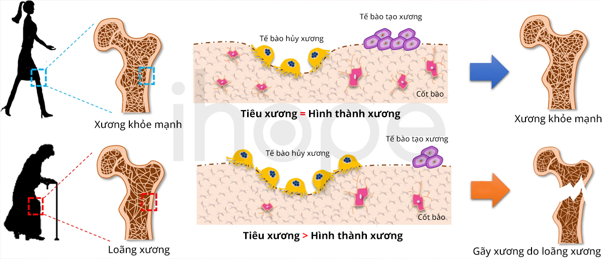 So Sánh Xương Khỏe Mạnh Và Loãng Xương