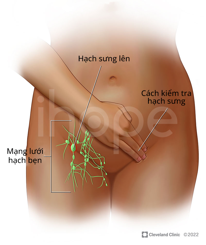 Sưng Hạch Bạch Huyết Bẹn
