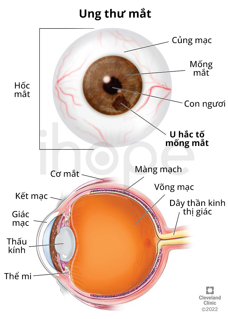 Ung Thư Mắt 1