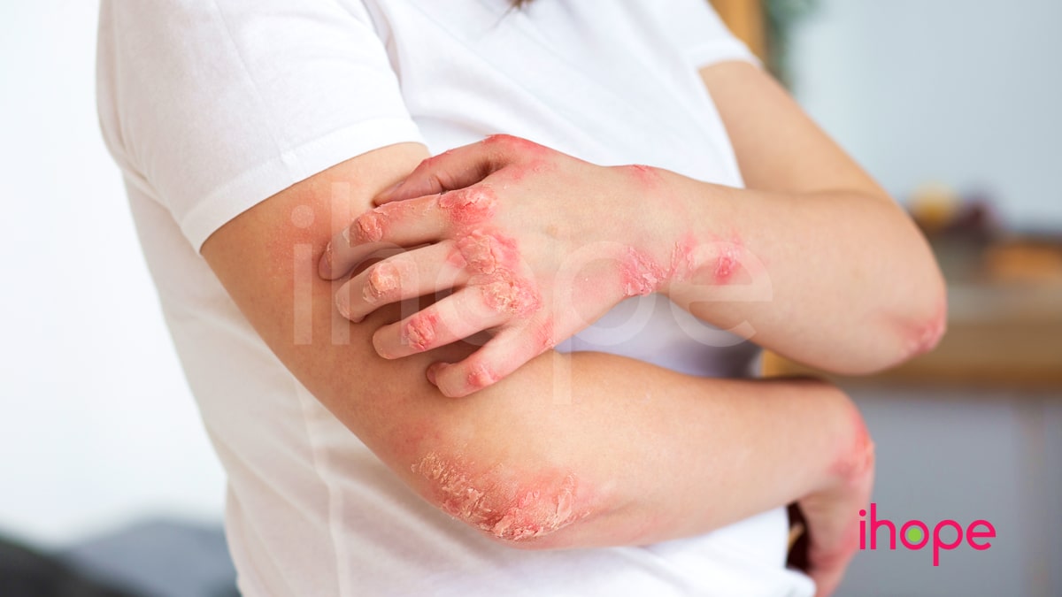 Bệnh Xơ Cứng Bẩm Sinh Min