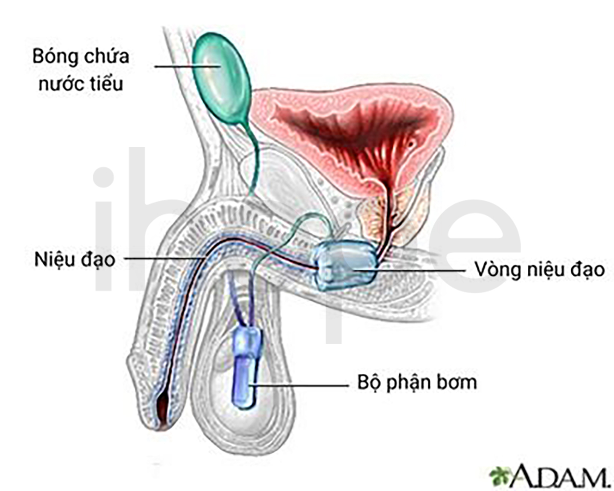 Cơ Thắt Niệu đạo Nhân Tạo