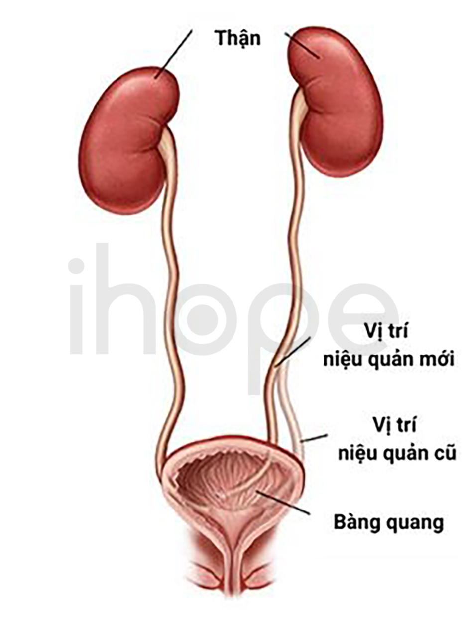 Đặt Lại Vị Trí Niệu Quản