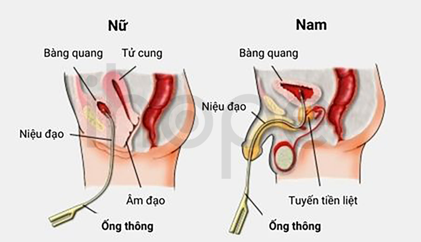 Đặt ống Thông Bàng Quang