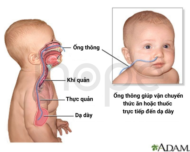 Đặt ống Thông Dạ Dày 1