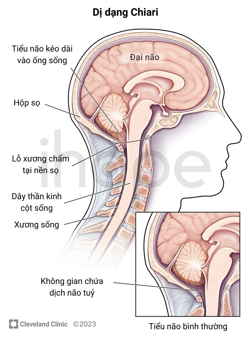 Dị Dạng Chiari