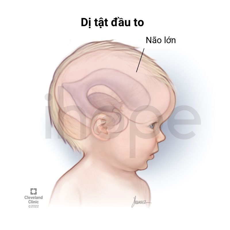 Dị Tật đầu To 1