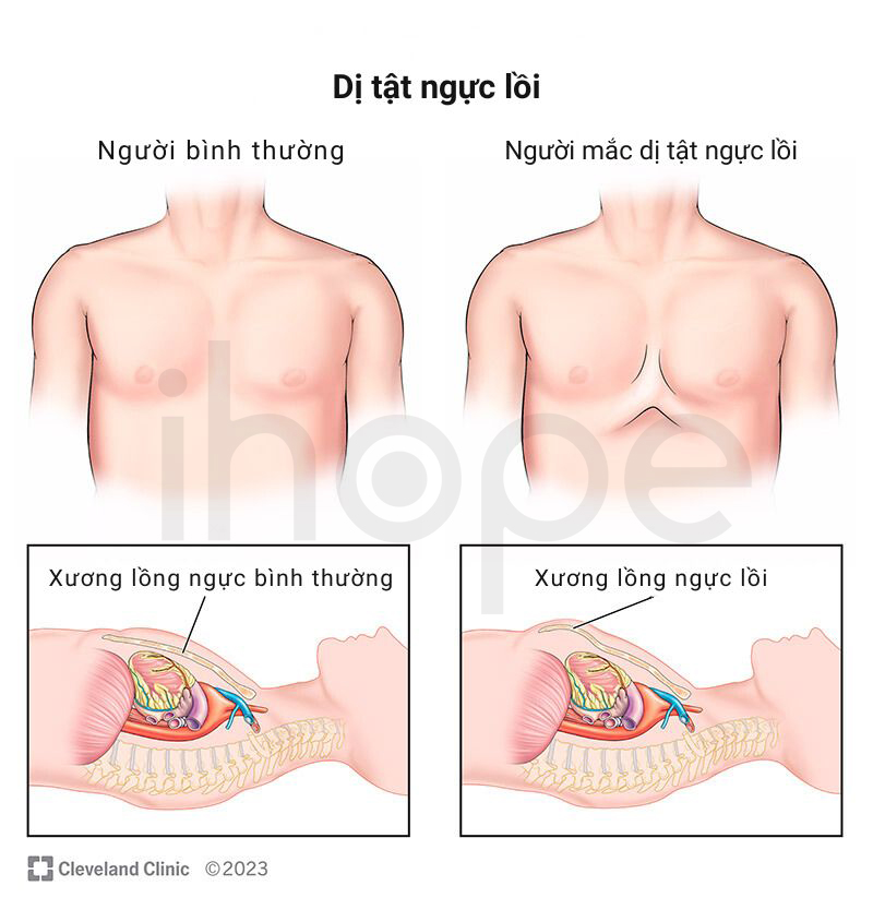 Dị Tật Ngực Lồi 1