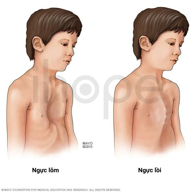 Dị Tật Ngực 1