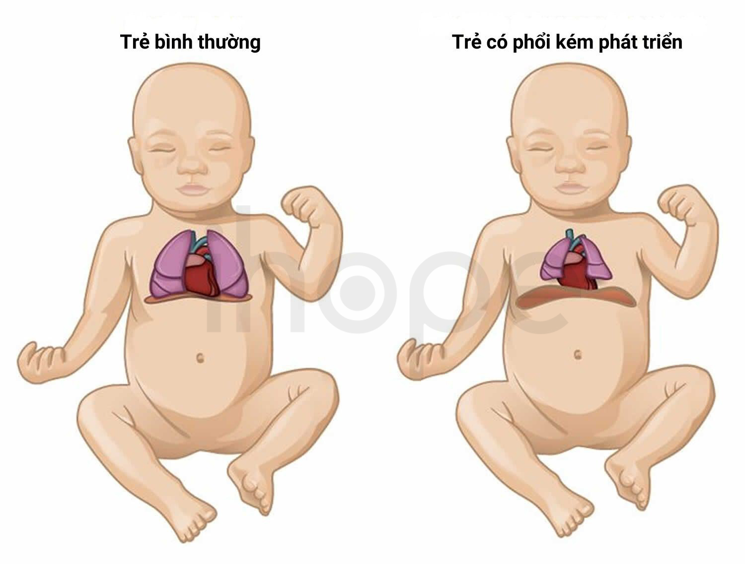 Giảm Sản Phổi