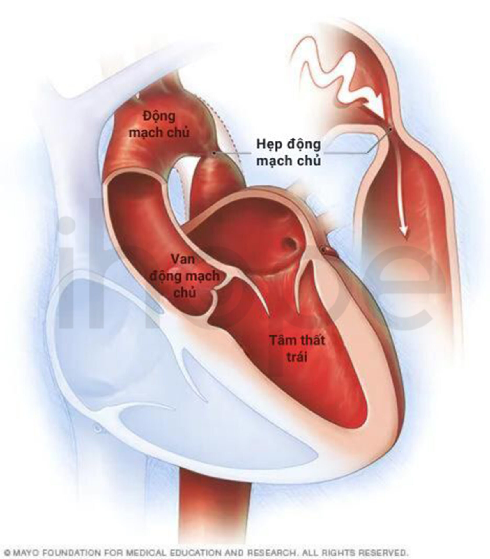 Hẹp động Mạch Chủ 1
