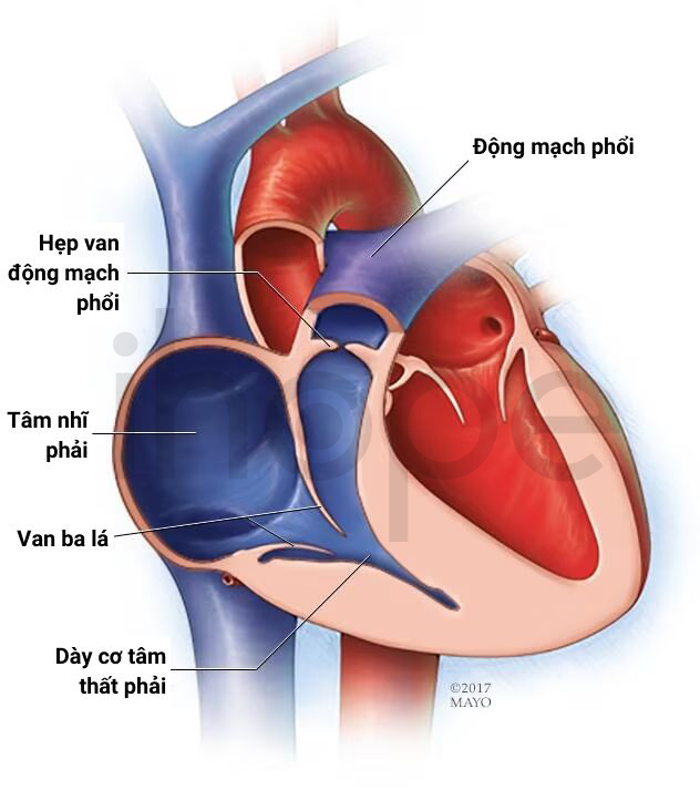 Hẹp động Mạch Phổi 1