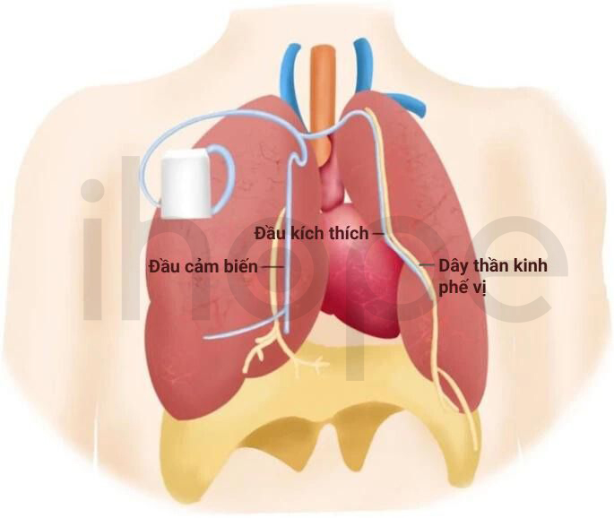 Kích Thích Dây Thần Kinh Phế Vị 1