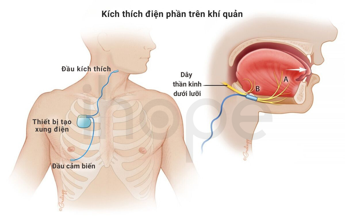 Kích Thích điện Phần Trên Khí Quản 1