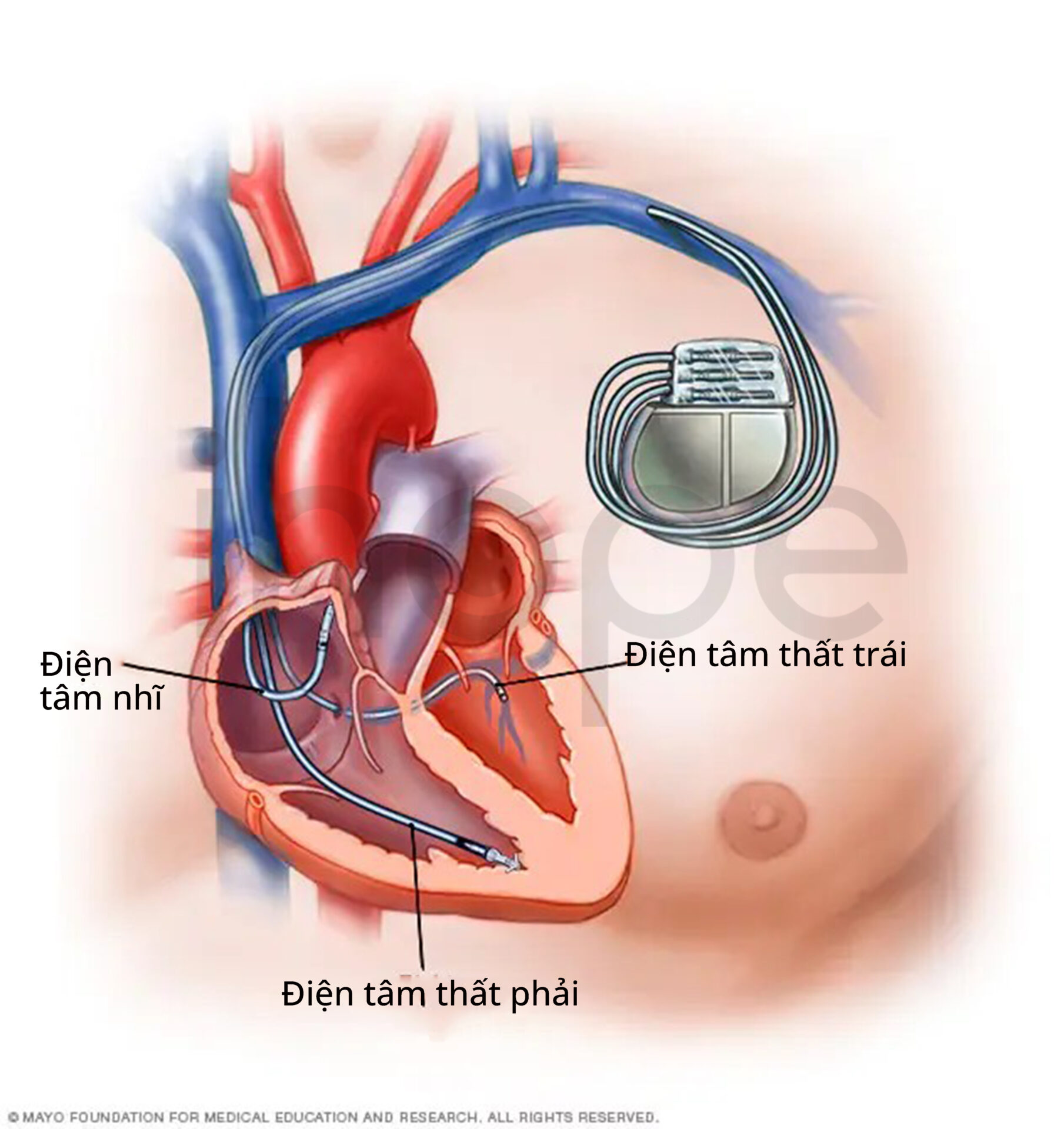 Máy Tạo Nhịp Tim