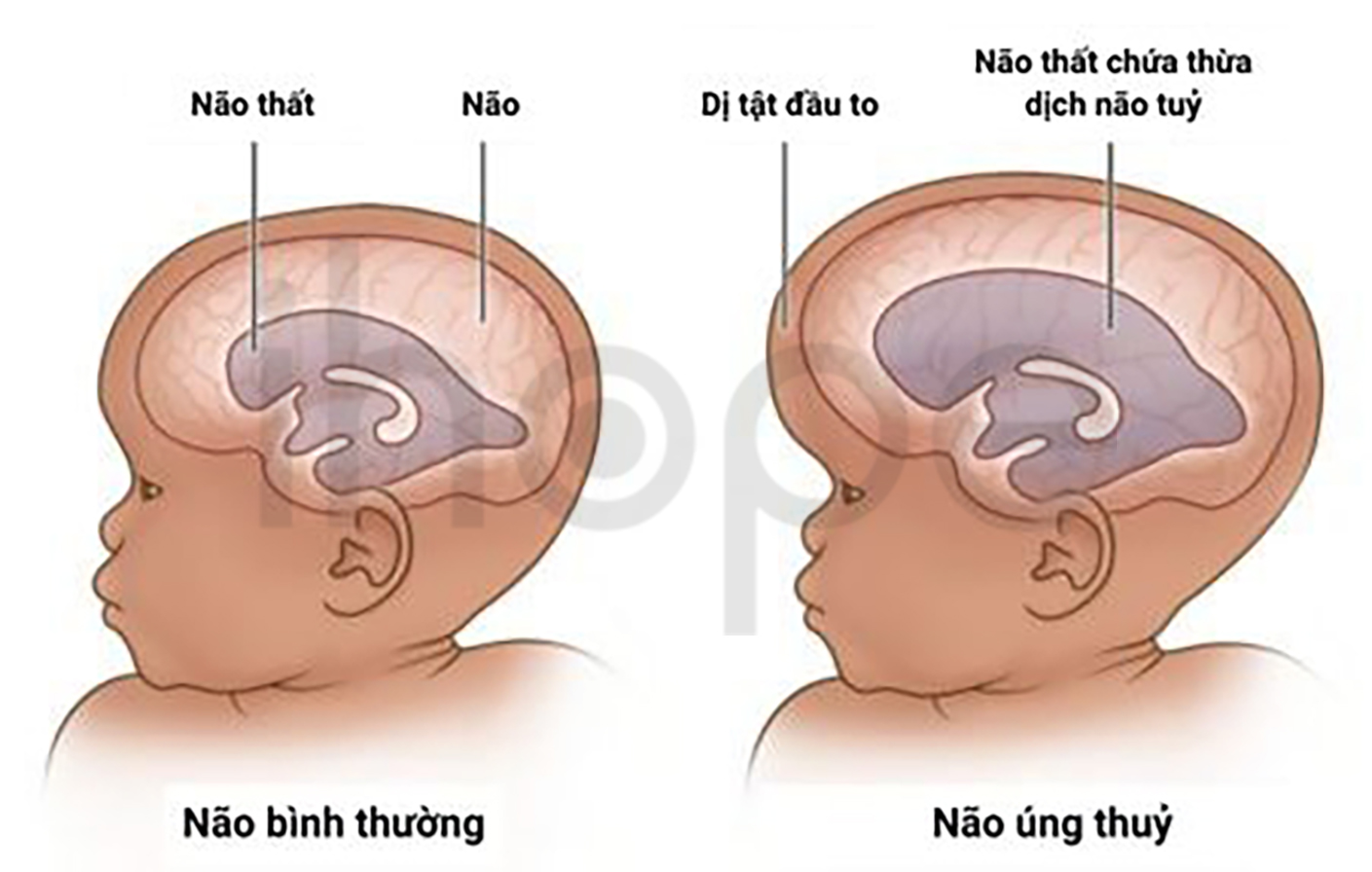 Não úng Thuỷ 1