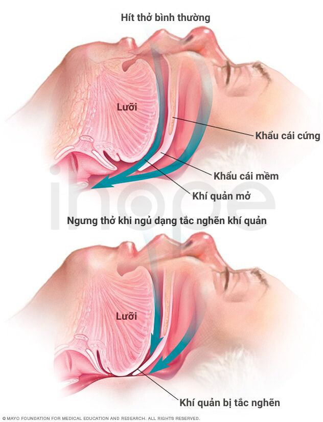 Ngưng Thở Khi Ngủ Dạng Tắc Nghẽn Khí Quản 1