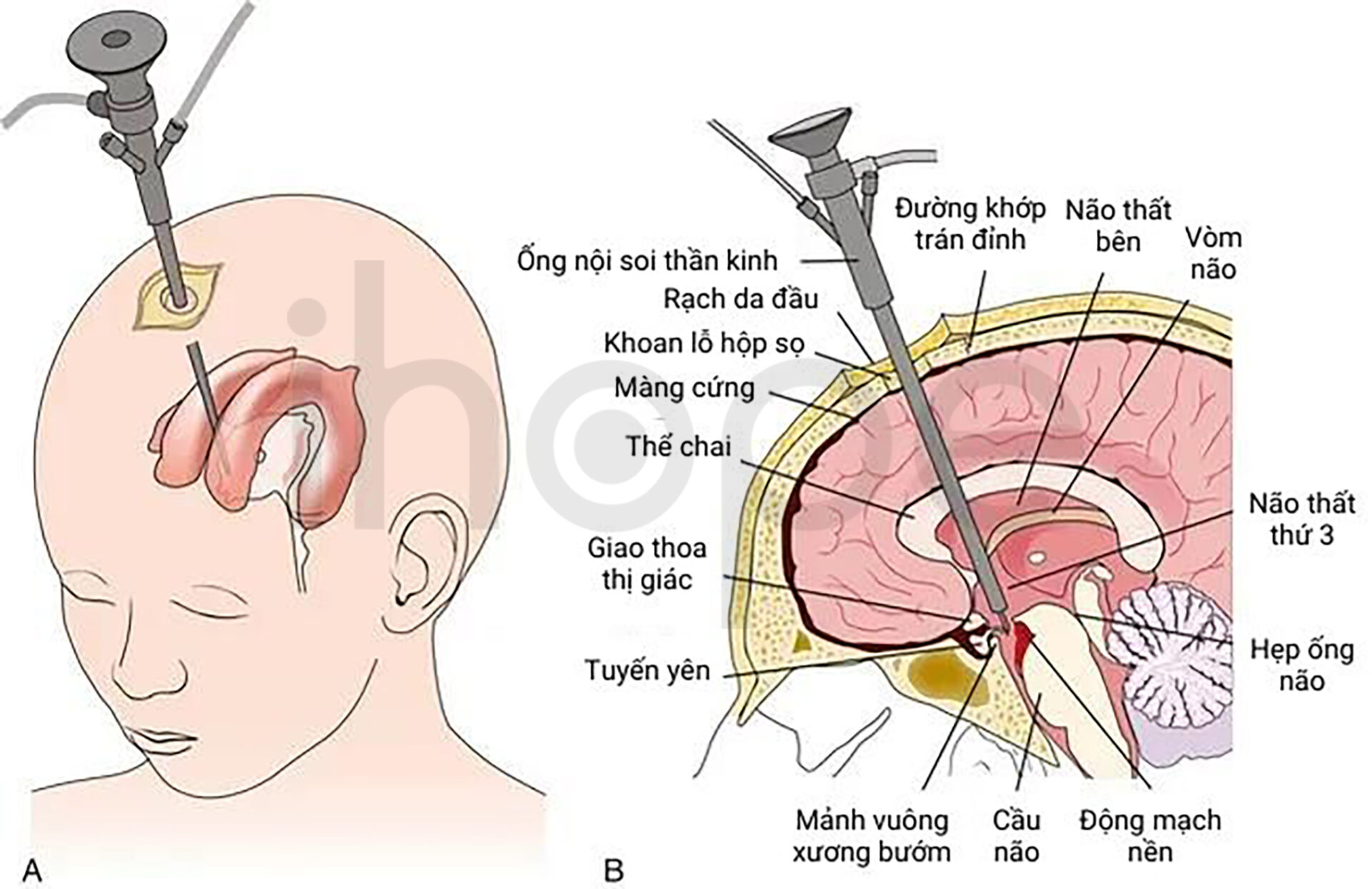 Nội Soi Mở Thông Sàn Não Thất Iii 1