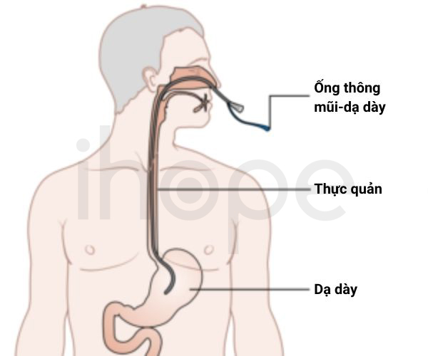 Ống Thông Mũi Dạ Dày 1