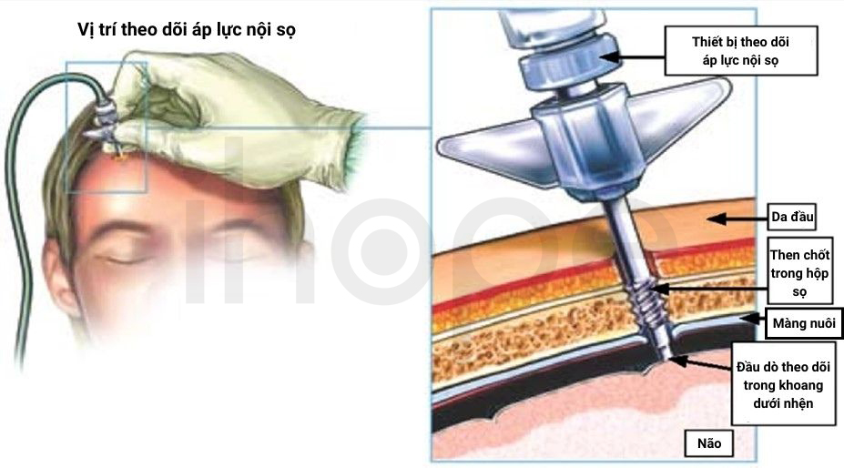 Theo Dõi áp Lực Nội Sọ 1
