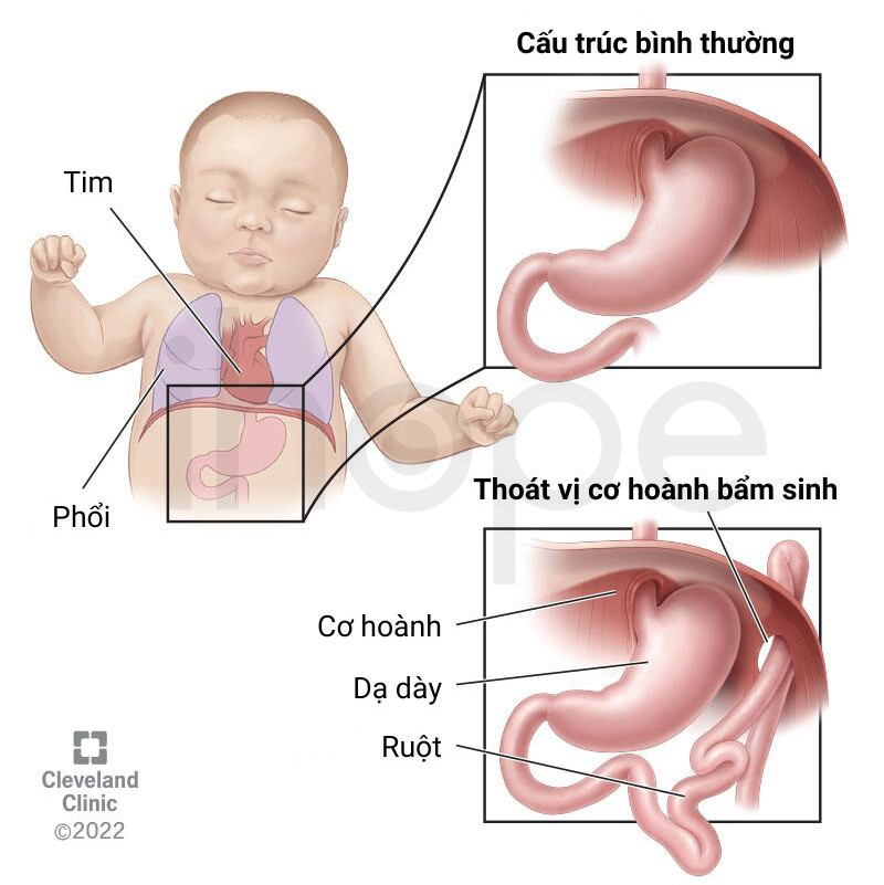 Thoát Vị Cơ Hoành 1