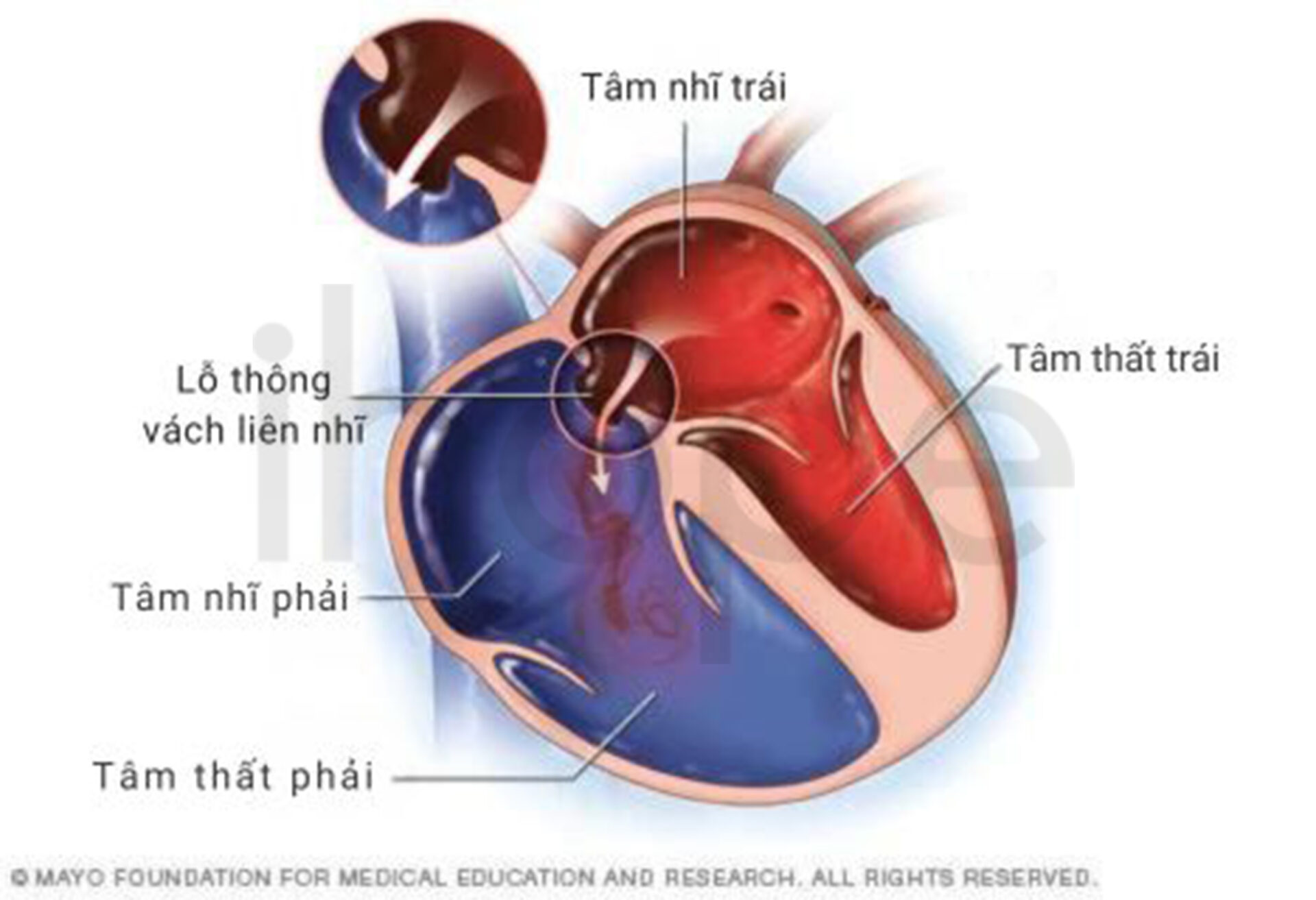 Thông Liên Nhĩ 1