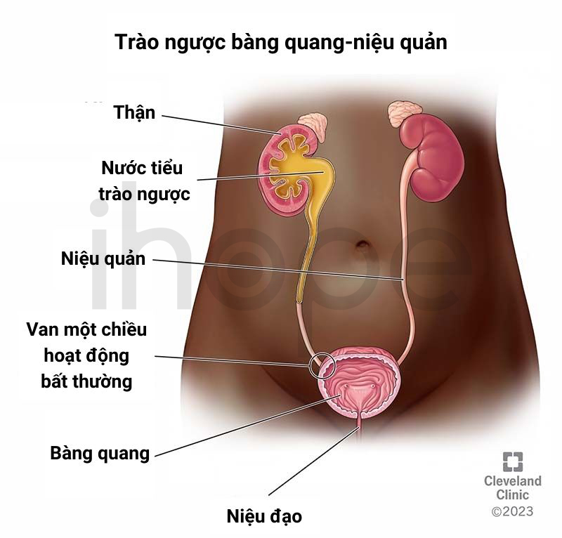 Trào Ngược Bàng Quang Niệu Quản 1