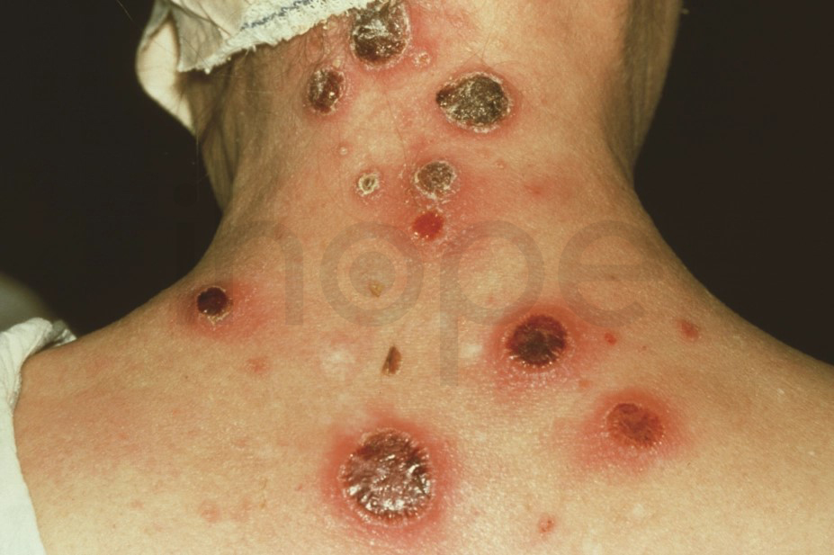 Triệu Chứng Của Bệnh Giang Mai Do Vi Khuẩn Treponema Pallidum Gây Ra