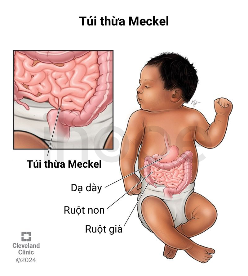 Túi Thừa Meckel 1