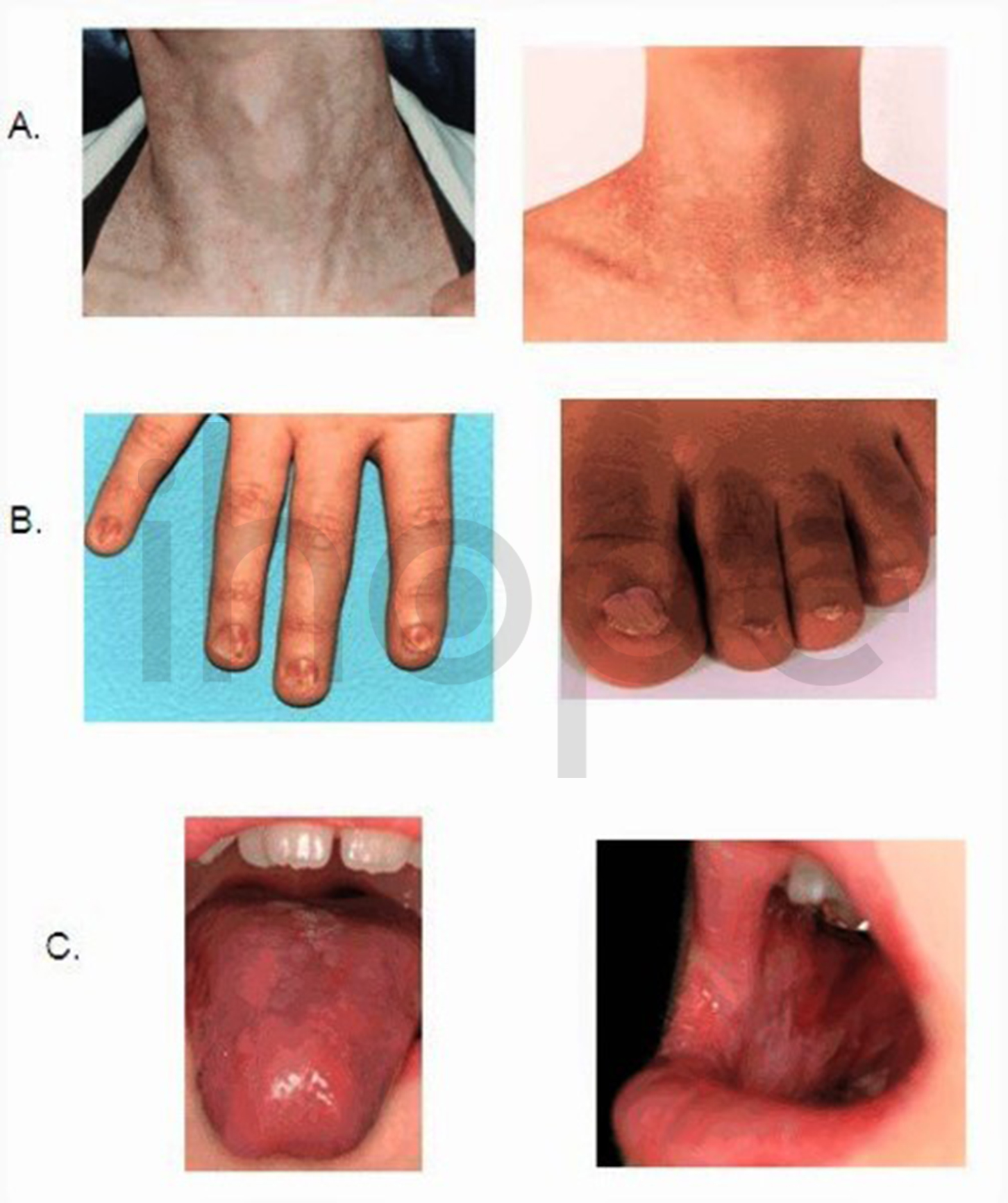 Ba Biểu Hiện Chính Của Bệnh Xơ Cứng Bẩm Sinh