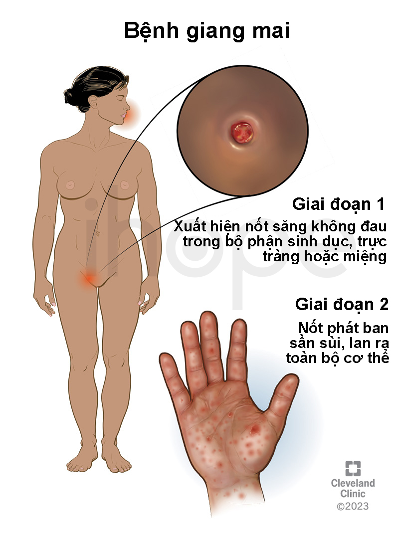 Bệnh Giang Mai