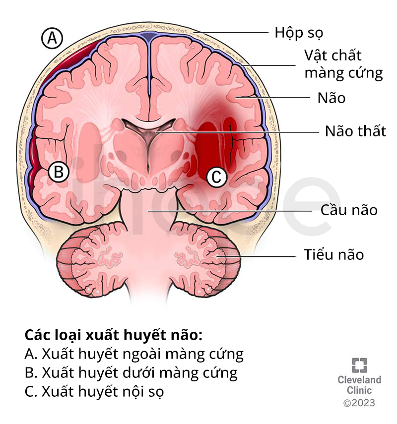 Các Vị Trí Xuất Huyết Não