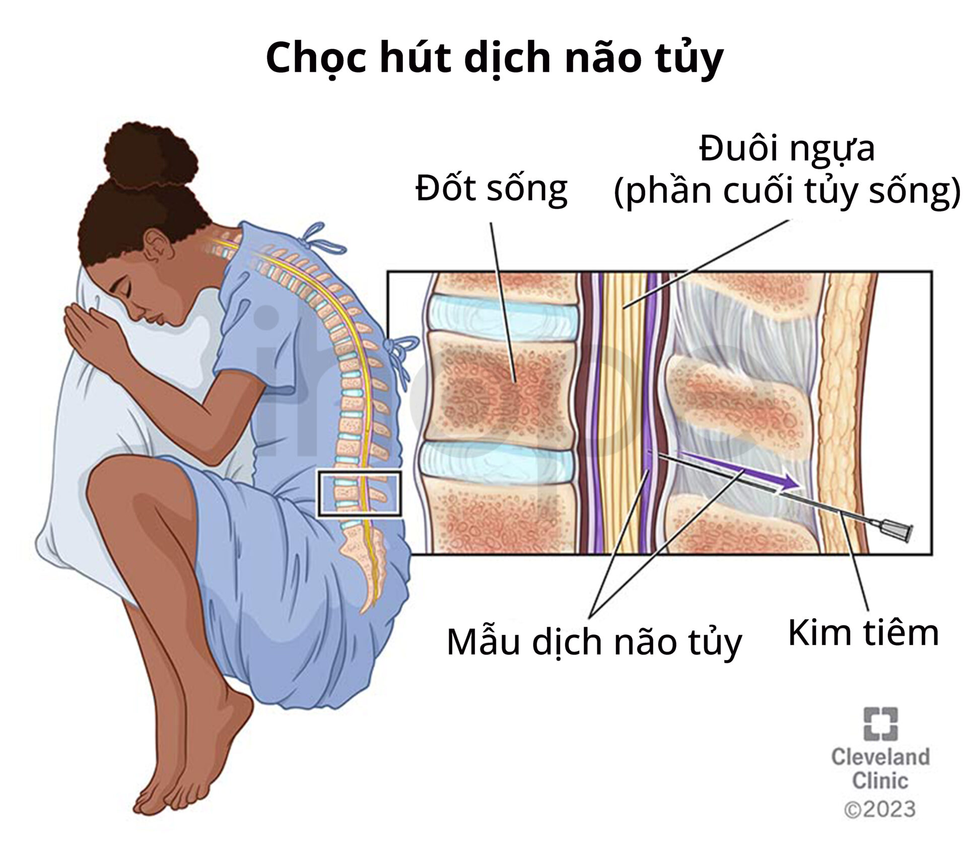 Chọc Hút Dịch Não Tủy