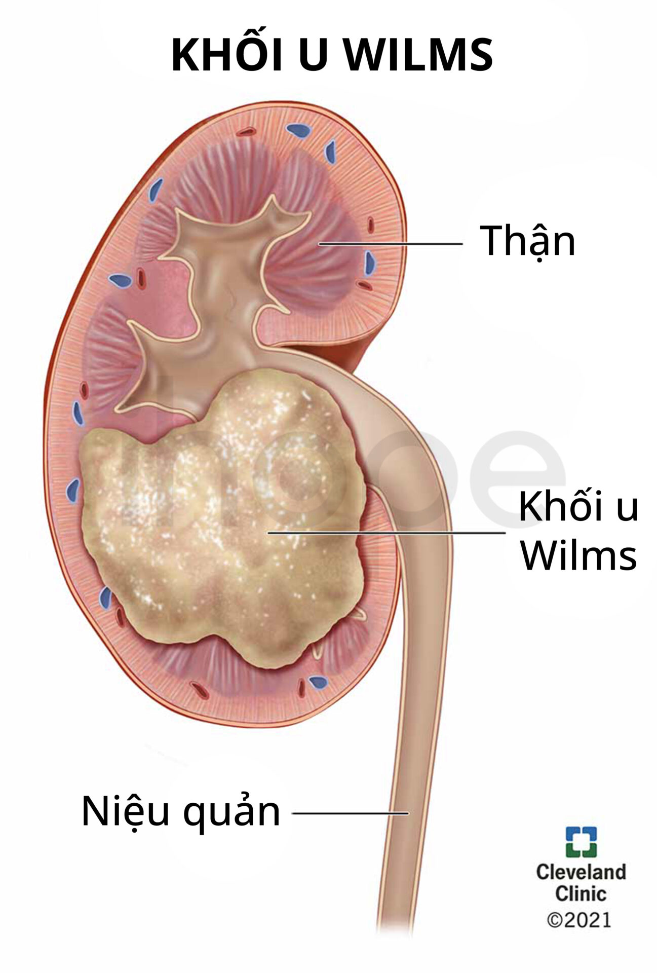 Khối U Wilms