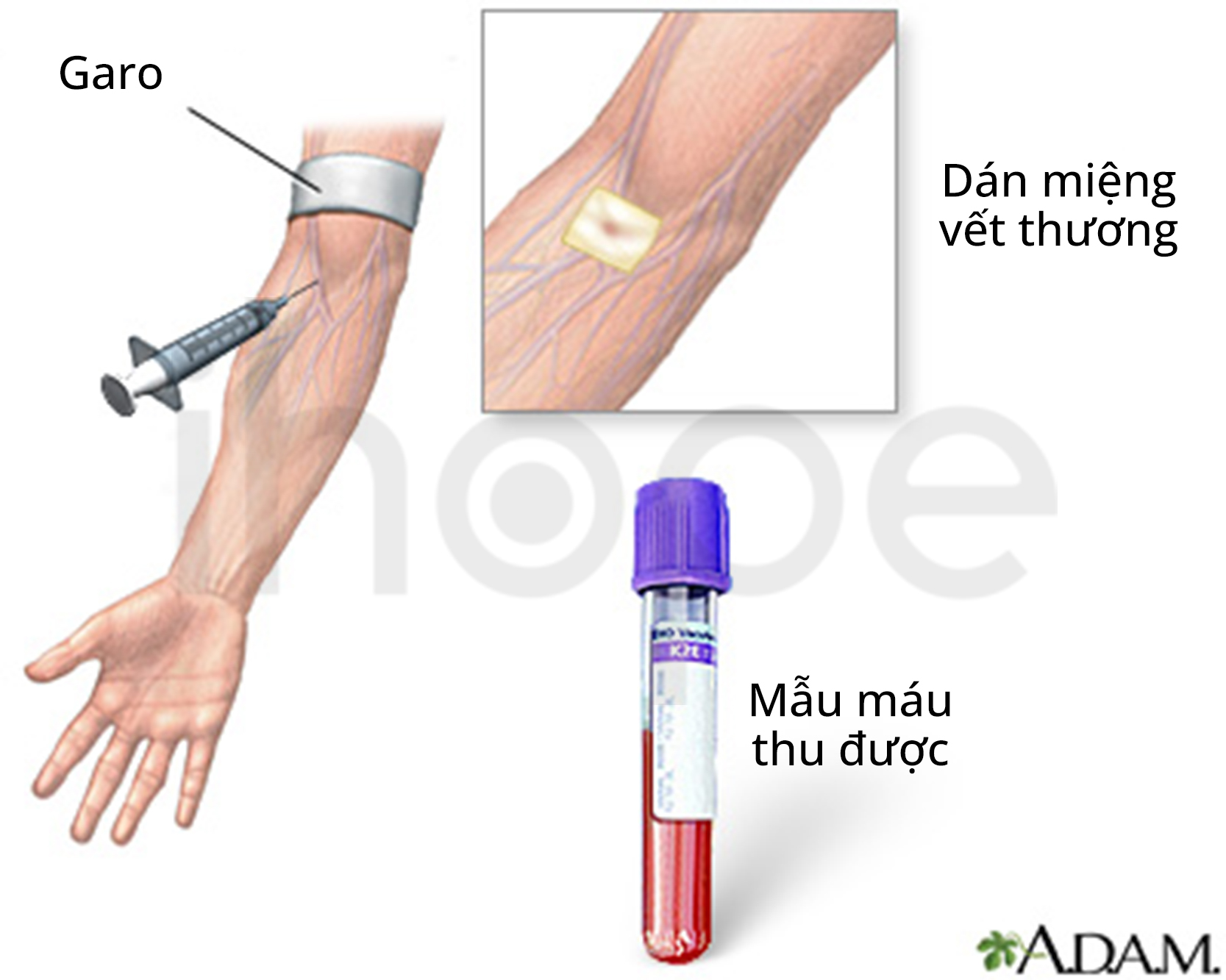 Lấy Máu Tĩnh Mạch