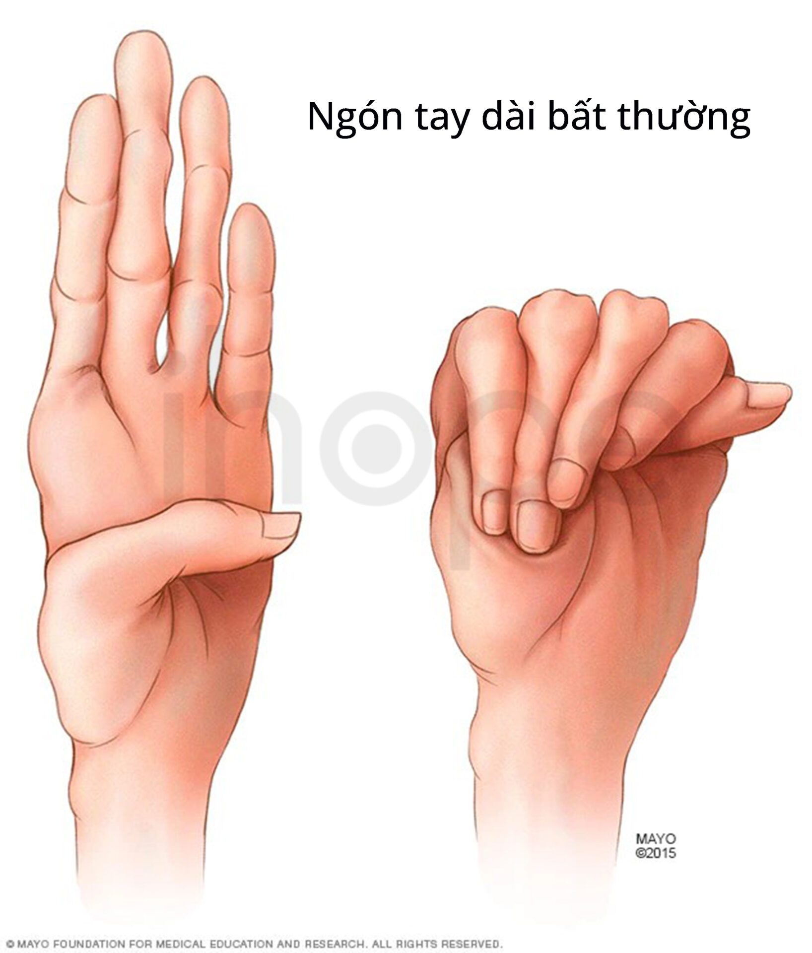 Ngón Tay Dài Bất Thường