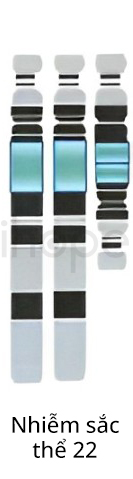 Nhiễm Sắc Thể 22 Của Người Bệnh Hội Chứng Mắt Mèo 2