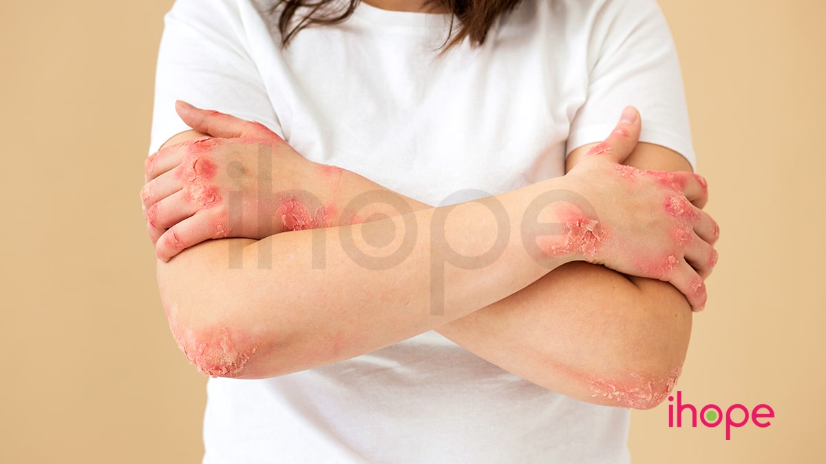 Tăng Sừng Biểu Bì Min