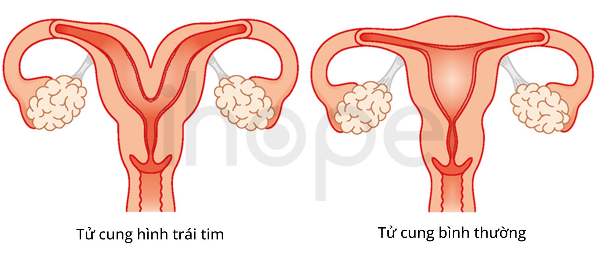 Tử Cung Hình Trái Tim