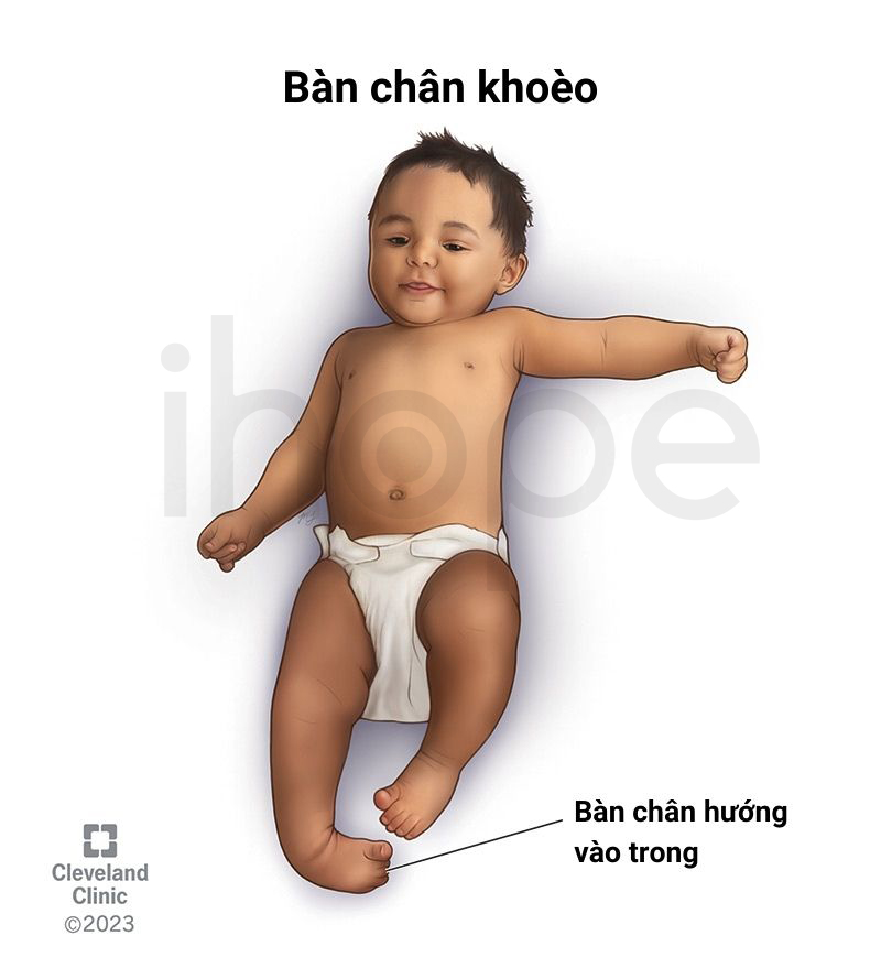 Bàn Chân Khoèo 1