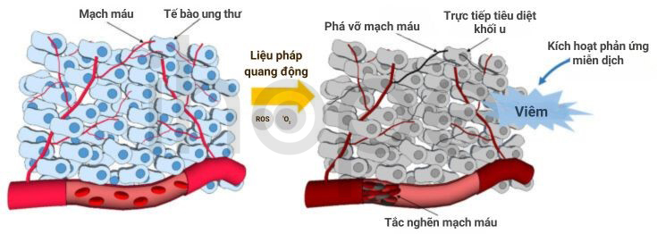 Cơ Chế Tiêu Diệt Khối U Của Liệu Pháp Quang động