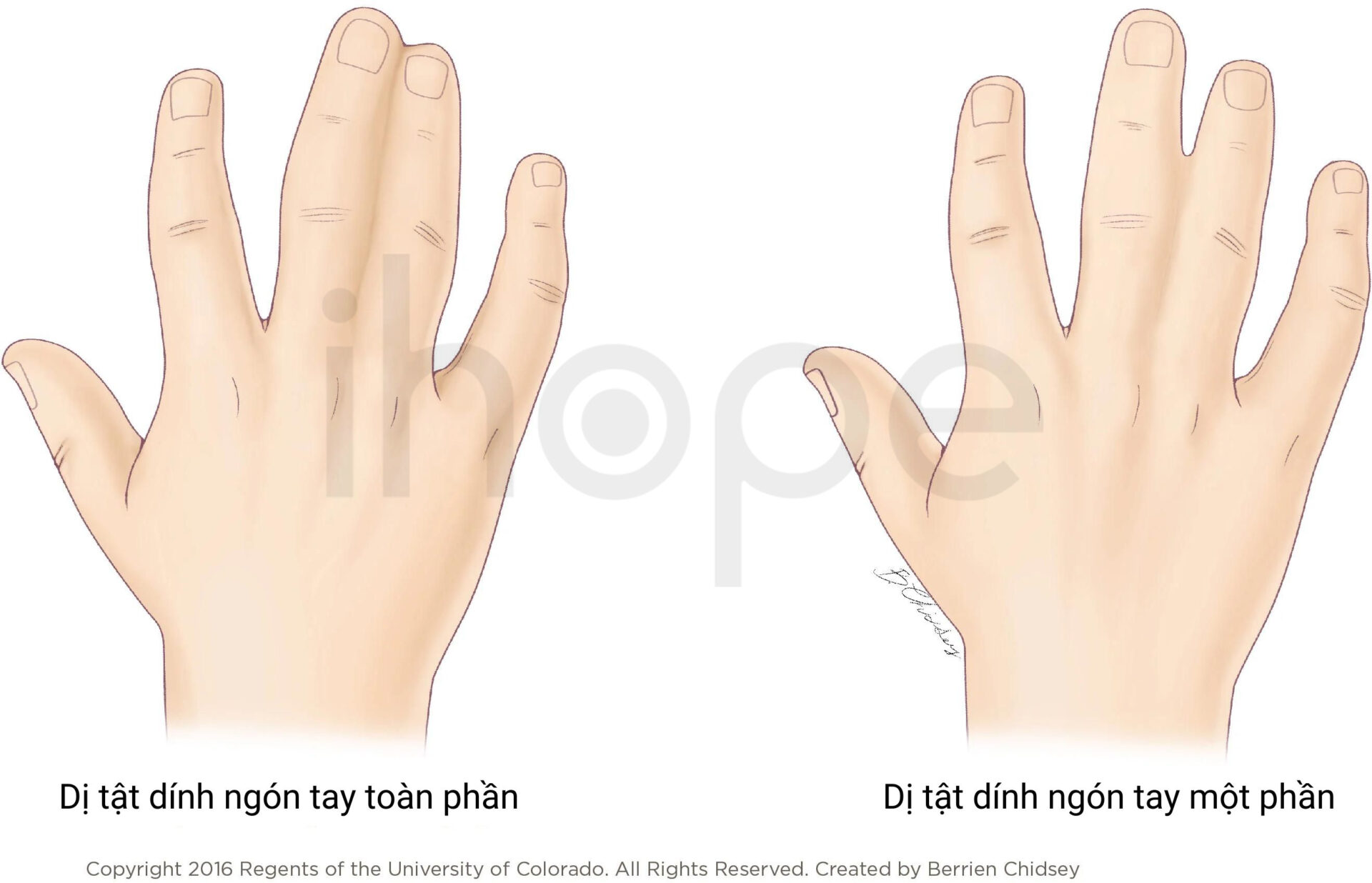 Dị Tật Dính Ngón Tay 1