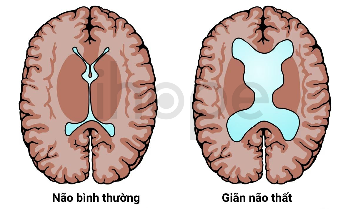 Giãn Não Thất 1
