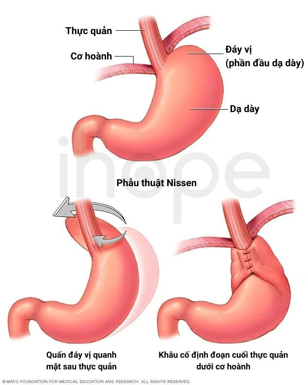 Phẫu Thuật điều Trị Trào Ngược Dạ Dày Thực Quản