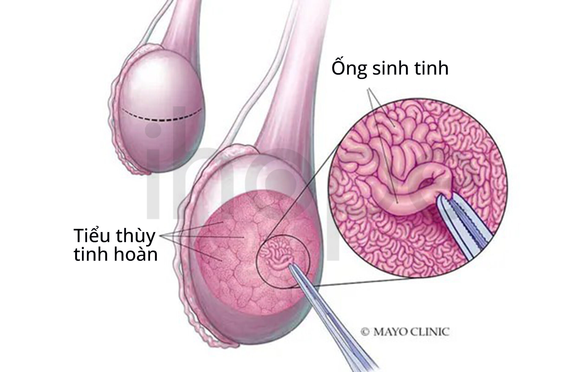 Sinh Thiết Tinh Hoàn