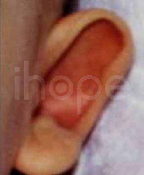 Tai Cụp Hình Chén
