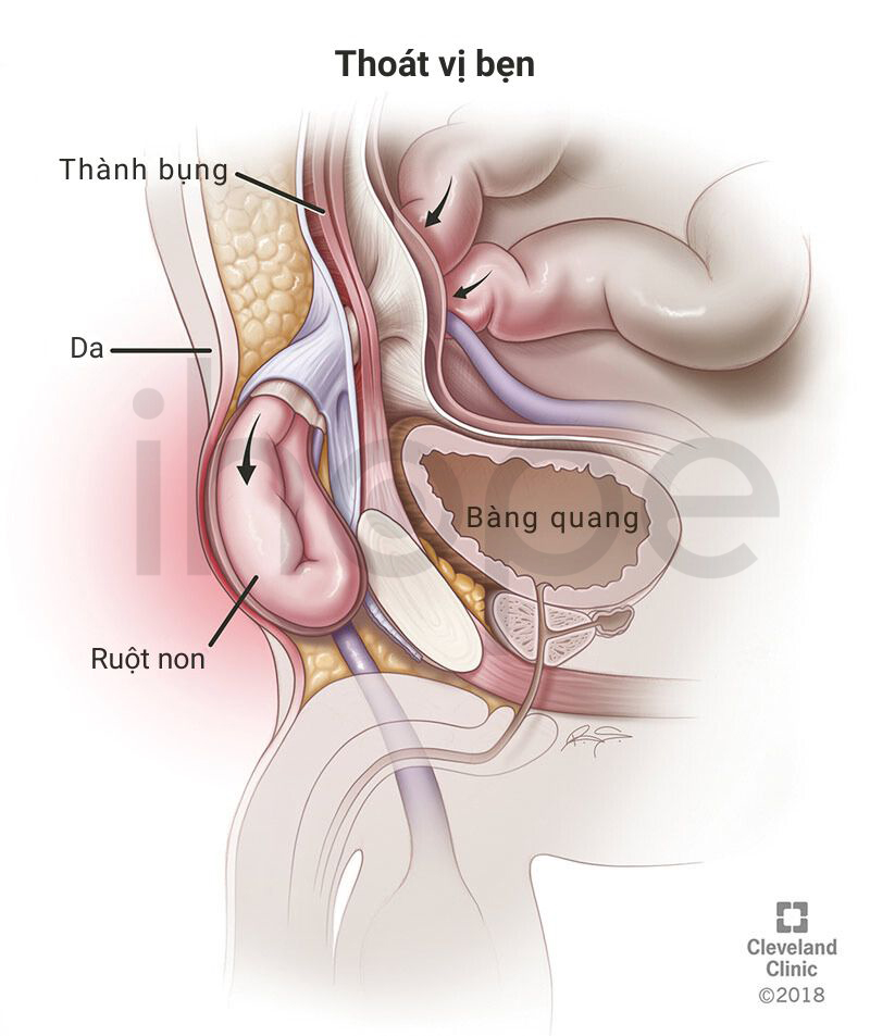 Thoát Vị Bẹn 1