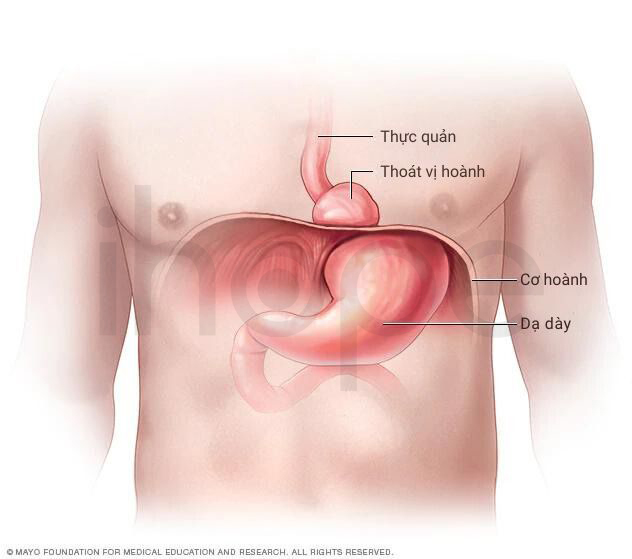 Thoát Vị Hoành 1