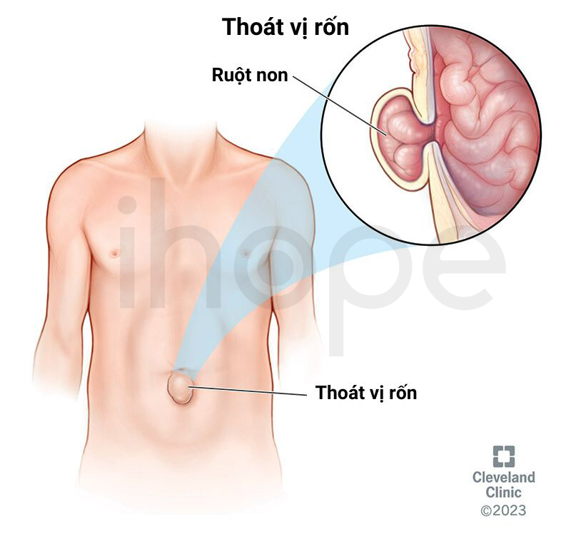 Thoát Vị Rốn 1