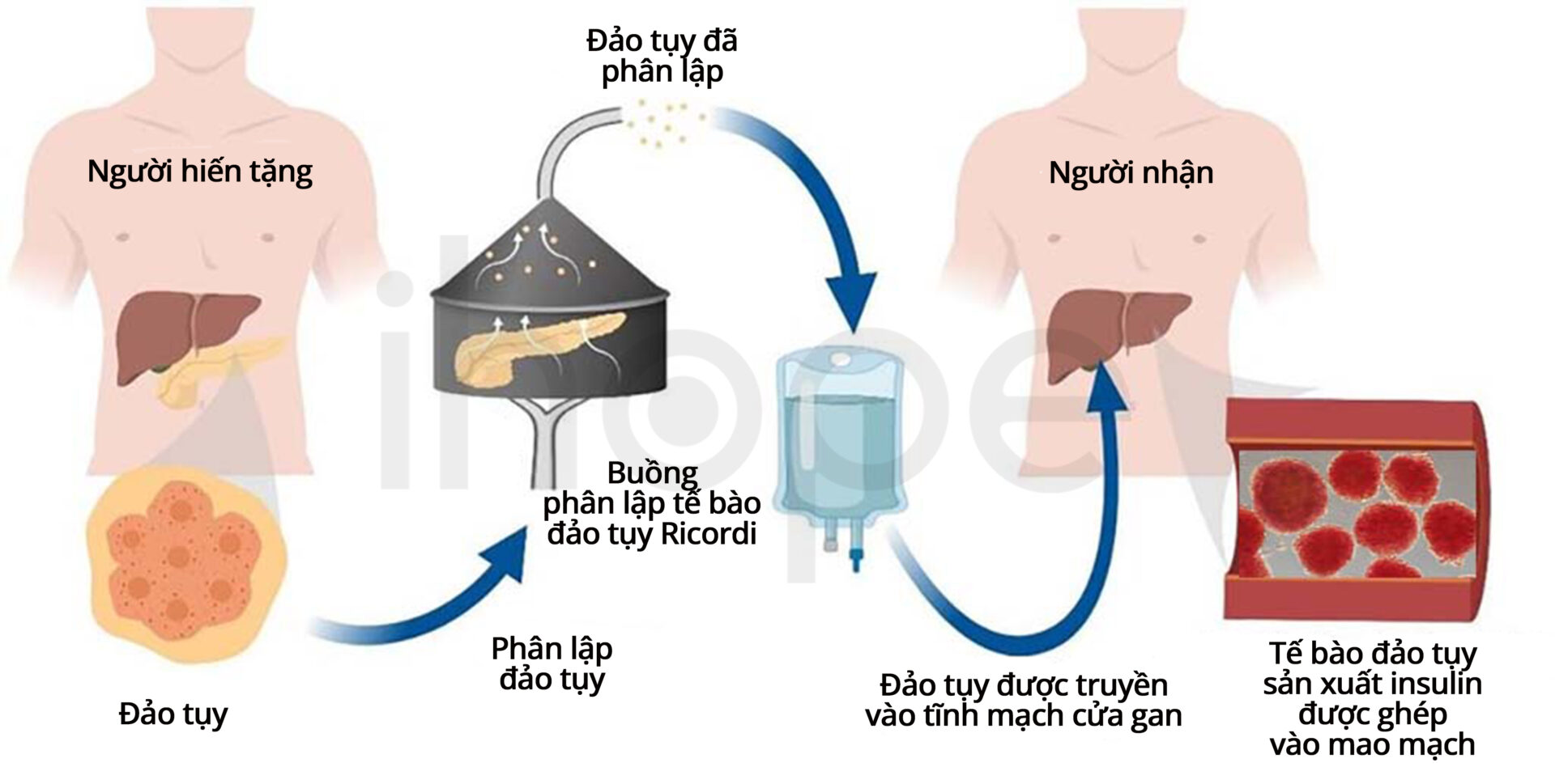 Cấy Ghép đảo Tụy